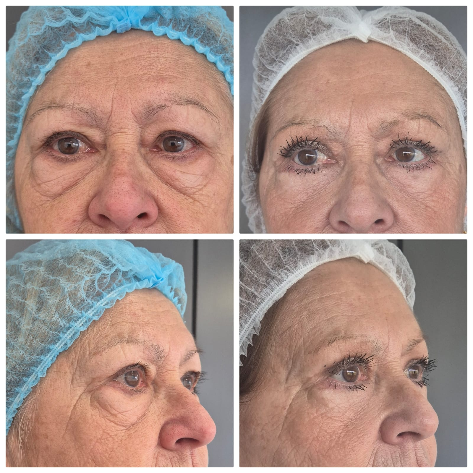 Blefaroplastía Simple — Antes y después de paciente Biotherapy