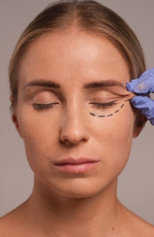 Blefaroplastia ( Evaluación )